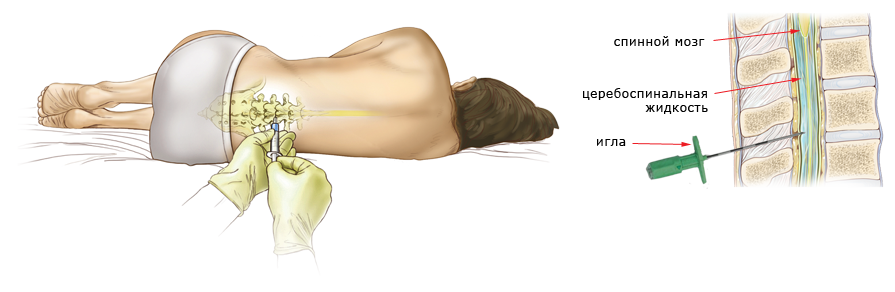 Процесс реабилитации после перелома шейки бедра и эндопротезирования тазобедренного сустава