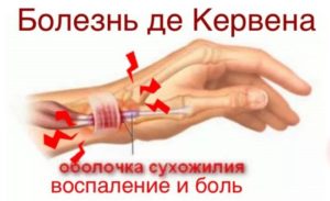 Причины, диагностика и лечение болей суставов пальцев рук
