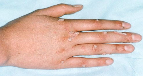 Как выглядят злокачественные папилломы на коже