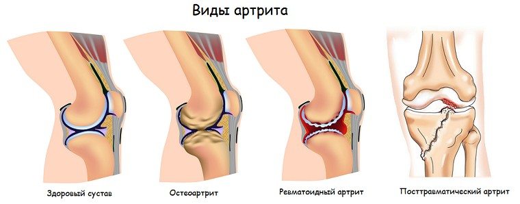 Симптомы артрита локтевого сустава и методы лечения