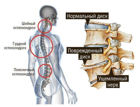 Причины появления хруста в позвоночнике при движении спиной