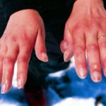 Причины, диагностика и лечение болей суставов пальцев рук