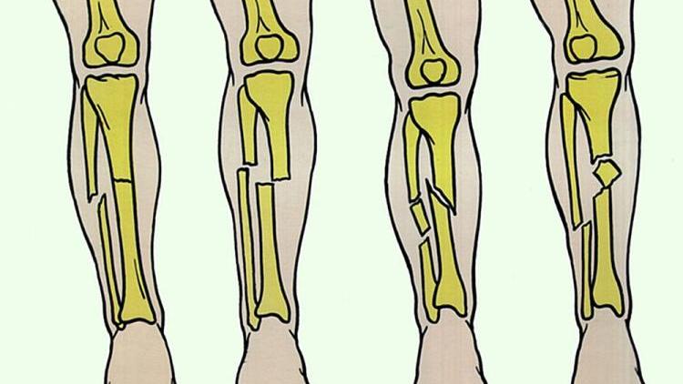 Факторы влияющие на процесс срастания костей после перелома