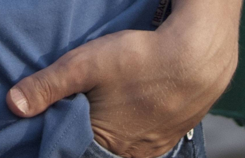 Причины развития брахидактилия большого пальца верхней или нижней конечности