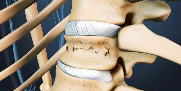 Методы лечения компрессионного перелома позвоночника поясничного отдела