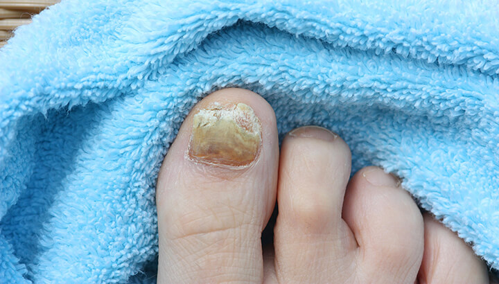 Грибок считается распространенной причиной желтых ногтей