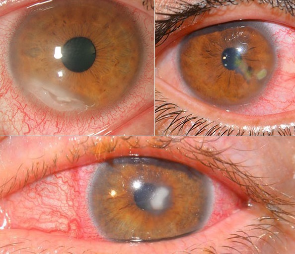Кератит глаза: фото, симптомы и лечение