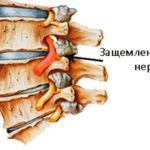 Как правильно использовать корсет для шеи при остеохондрозе