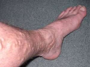 Уплотнение на ноге под кожей