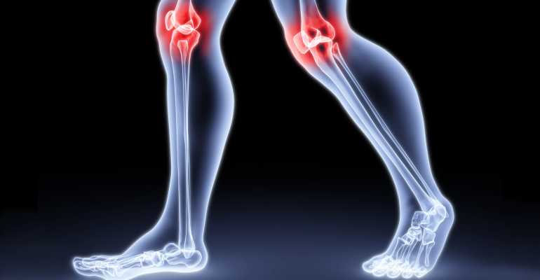 Что такое варусная деформация коленных суставов и как с этим бороться