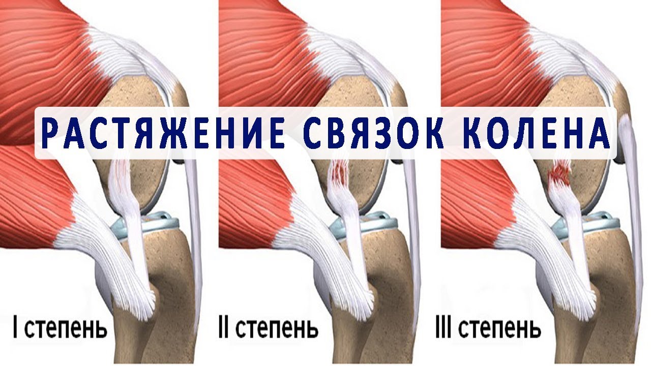 Разрыв связок коленного сустава