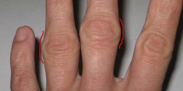 Шишка на пальцах рук - симптом артроза