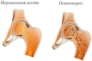 По каким признакам можно определить перелом костей