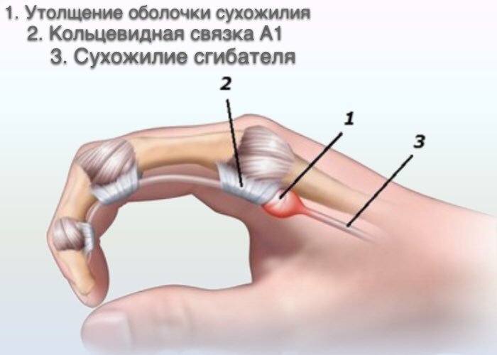 Причины, симптомы и лечение стенозирующего лигаментита