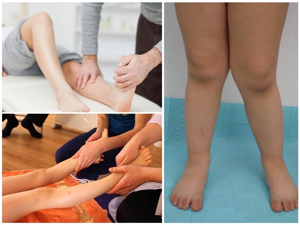 Что такое варусная деформация коленных суставов и как с этим бороться