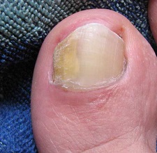 Чем лечить грибок ногтей на ногах: лучшие препараты и народные средства